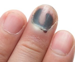 What can we do against black toenail fungus